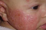 Staphylococcus aureus nei bambini: sintomi, trattamento e misure di prevenzione